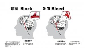 气温骤降可引发缺血性脑卒中