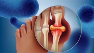 尿酸管理新突破！重磅三甲医院临床发布，力证「降小益®乳酸菌粉Purineed™系列」的尿酸代谢实力