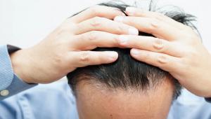 直击男性“秃”势：如何撬动900亿头顶经济这座“富矿”？